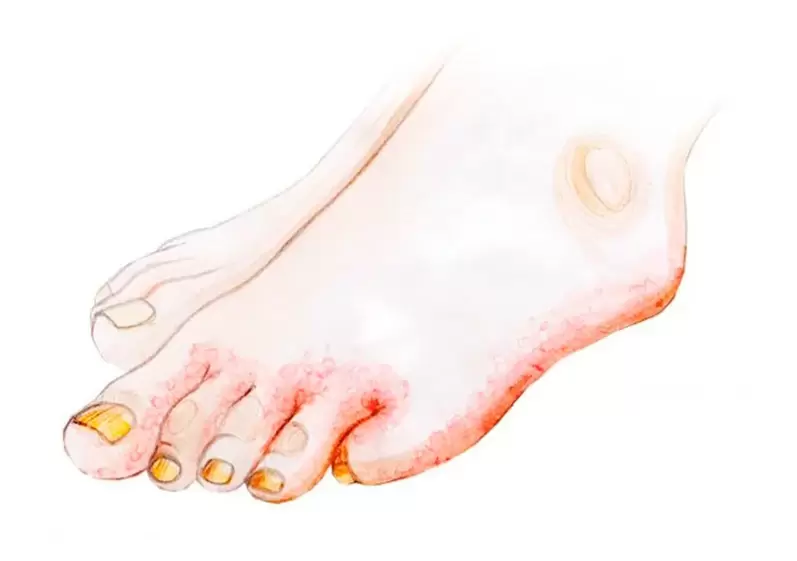 Ciuperca pe degetele de la picioare și modul de aplicare a cremei Zenidol