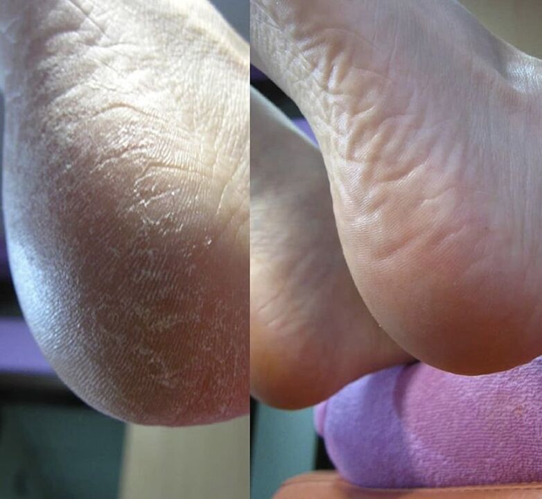 Fotografie a călcâiului piciorului înainte și după utilizarea cremei Zenidol