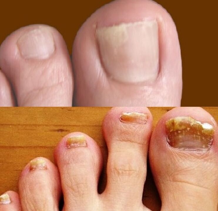 ciuperca unghiilor de la picioare