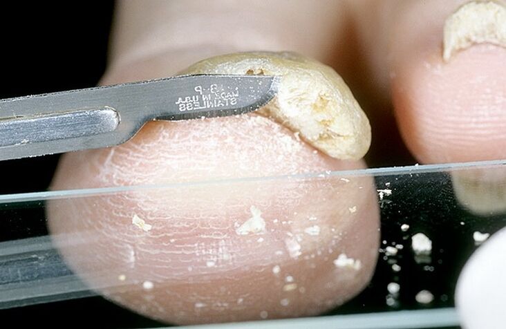 răzuirea unghiilor pentru a diagnostica ciuperca