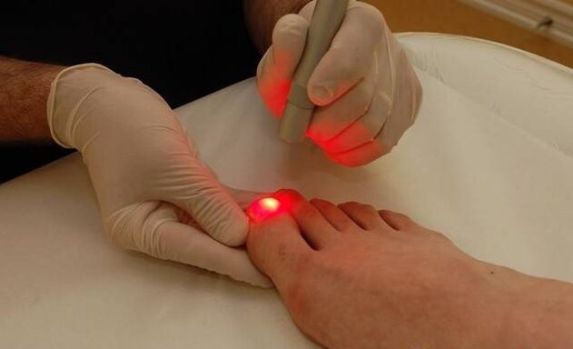 tratament cu laser pentru ciuperca unghiilor de la picioare