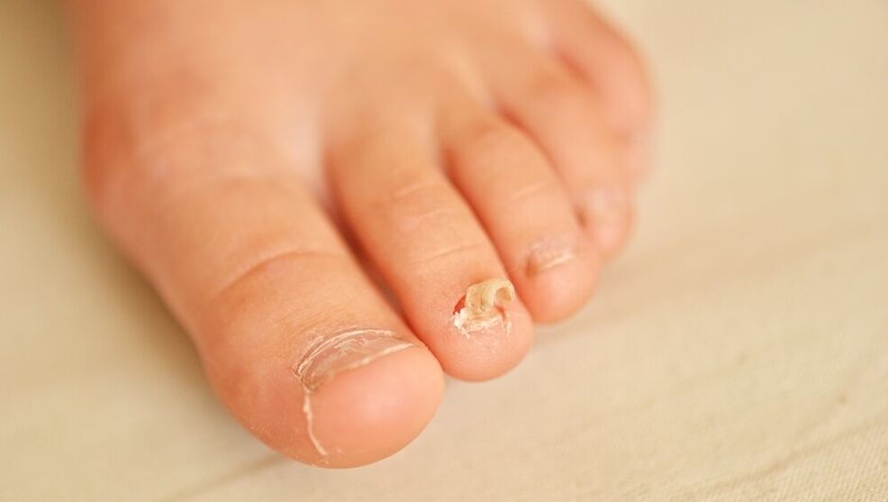 simptome ale ciupercii unghiilor de la picioare