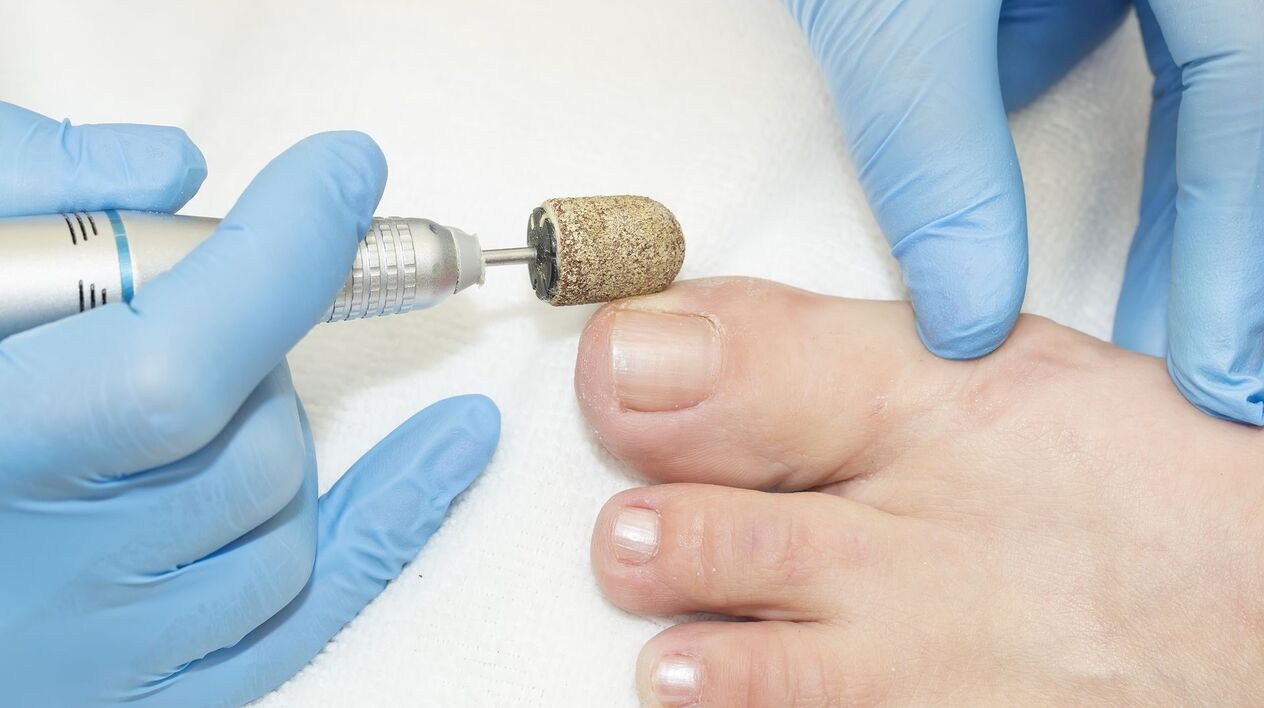 tratamentul hardware al ciupercilor de pe unghiile picioarelor