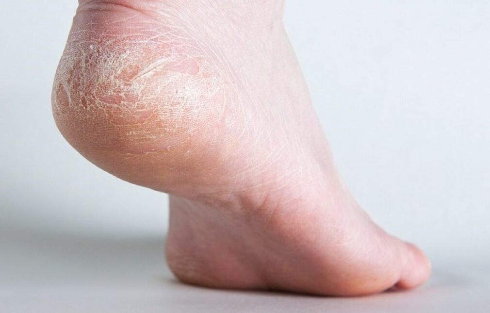ciuperca pielii de pe picior cum să trateze