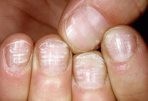 infecție fungică a plăcii unghiei