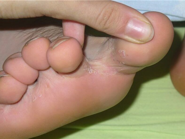 simptome ciupercii degetelor de la picioare