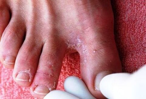 ciuperca dintre degetele de la picioare