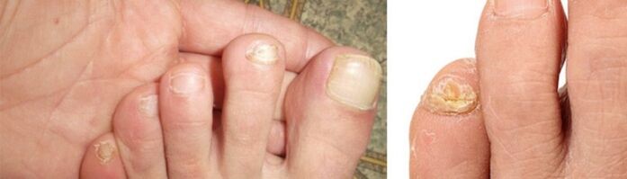 fotografie a manifestărilor de ciuperci pe unghiile de la picioare
