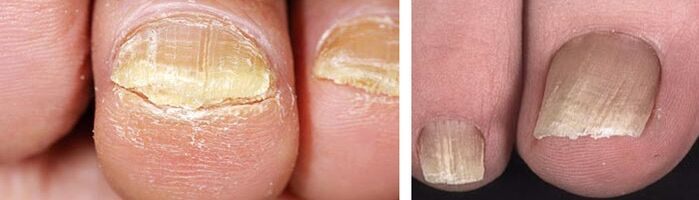 deteriorarea unghiilor cu o infecție fungică