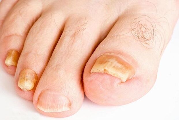 cum arată ciuperca unghiilor de la picioare