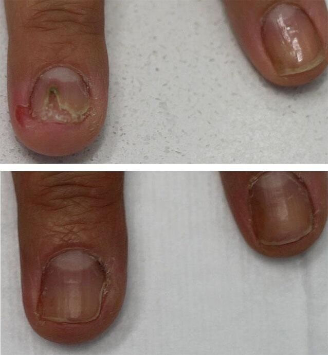 infecție fungică a unghiilor de la picioare