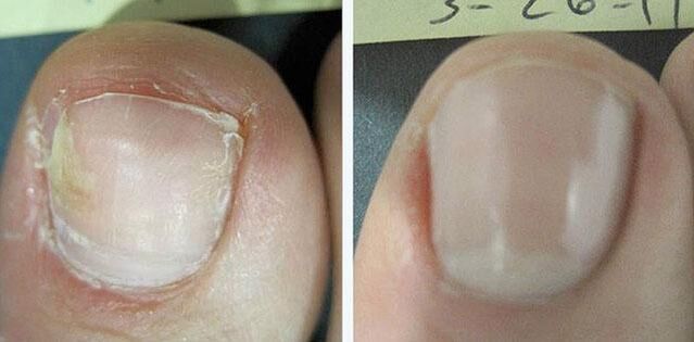 înainte și după tratamentul ciupercii unghiei