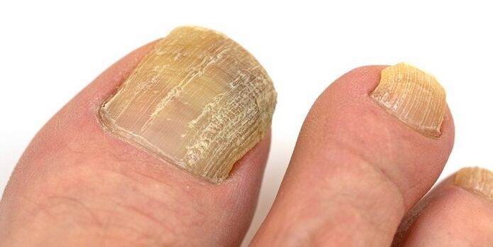 deteriorarea unghiilor cu infecție fungică avansată