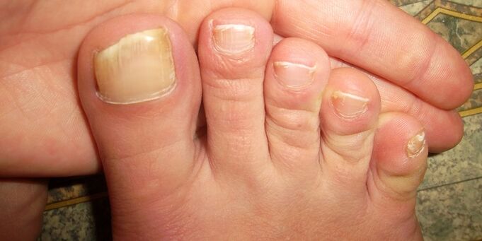 deteriorarea unghiilor de la picioare cu ciuperci