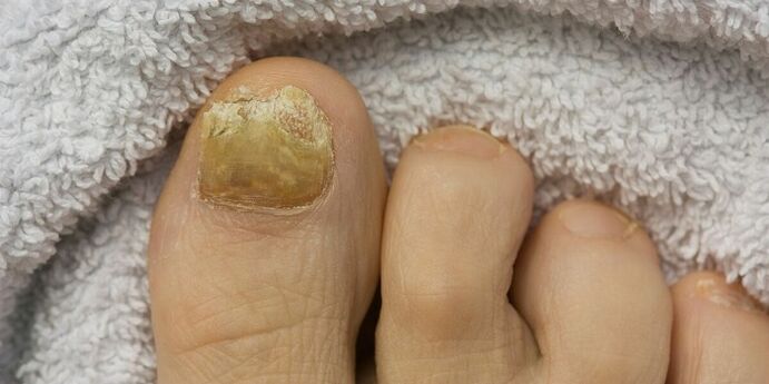 toenail galben cu infecție fungică
