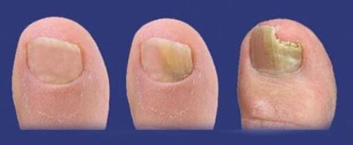 etapele de dezvoltare a ciupercii pe unghiile de la picioare