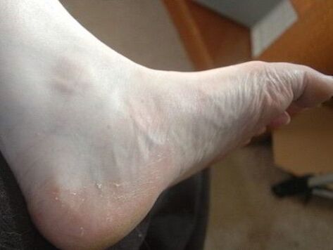 peelingul piciorului piciorului ca semn al infecției fungice