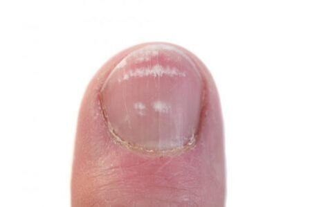 stadiul inițial al infecției cu ciuperca unghiilor