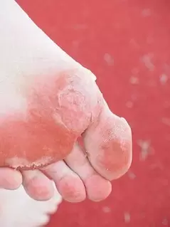 simptome ale ciupercii piciorului